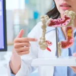 New Blood Tests for Colon Cancer Amid Rising Cases in Young Adults