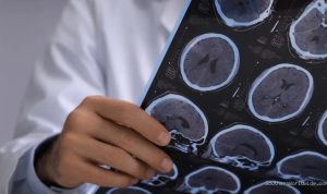 Doctors Mistake Brain Cancer for Live Tapeworms